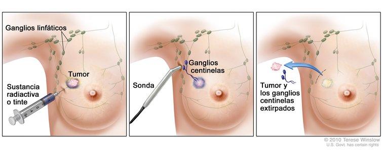 dolor ganglios axilares hombres